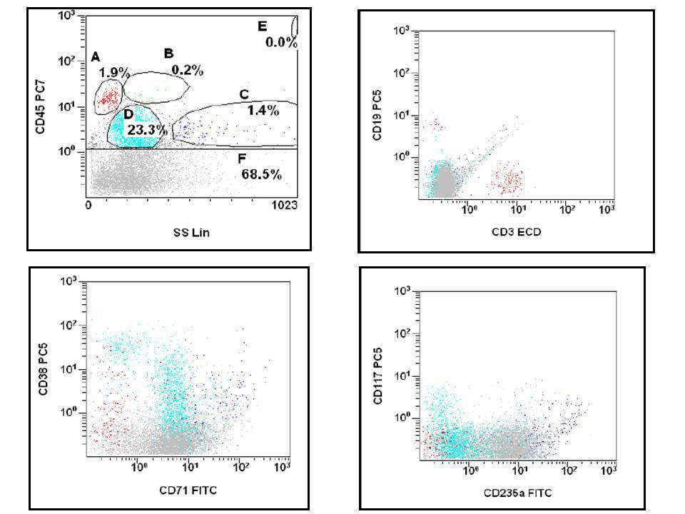 The flow cytometric analysis of this bone marrow case demonstrates that approximately 25% of events are within the immature cell/blast gate, and 67% of events are within the CD45-negative gate. Both the blast and CD45-negative populations express CD71; however, the blast population is negative for CD235a.